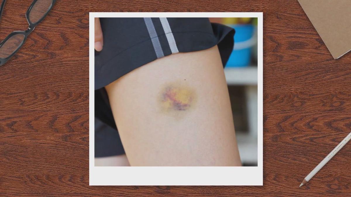 'Video thumbnail for Permanent Bruises (Hemosiderin Staining): Causes, Risks, and Treatment'