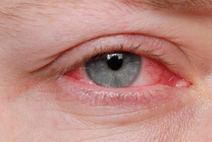 Causes of Conjunctivitis