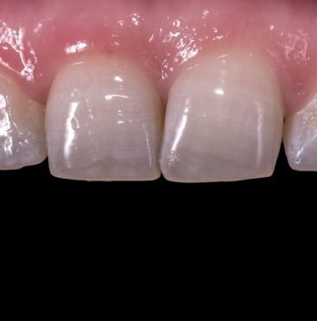 How to Fix Translucent Teeth Naturally