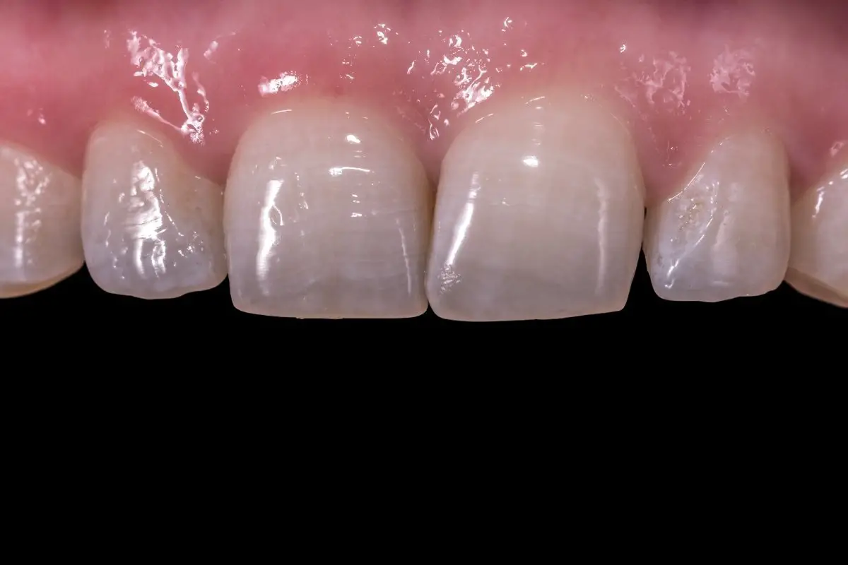 The Length Of Time Does Laser Teeth Bleaching Last?