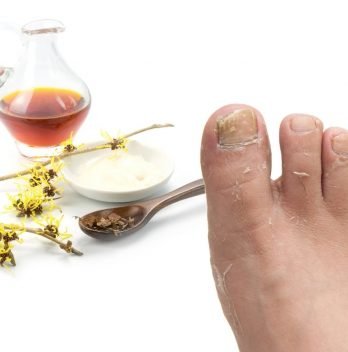 Witch Hazel for Athlete's Foot - How to Use and Safety Information