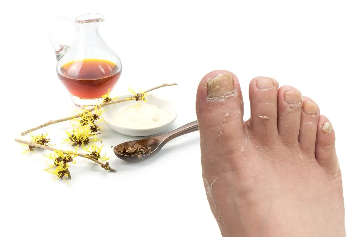 Witch Hazel for Athlete's Foot - How to Use and Safety Information