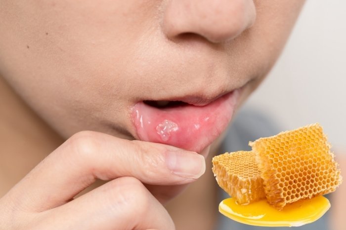 Beeswax for Swelling And Oral Sores