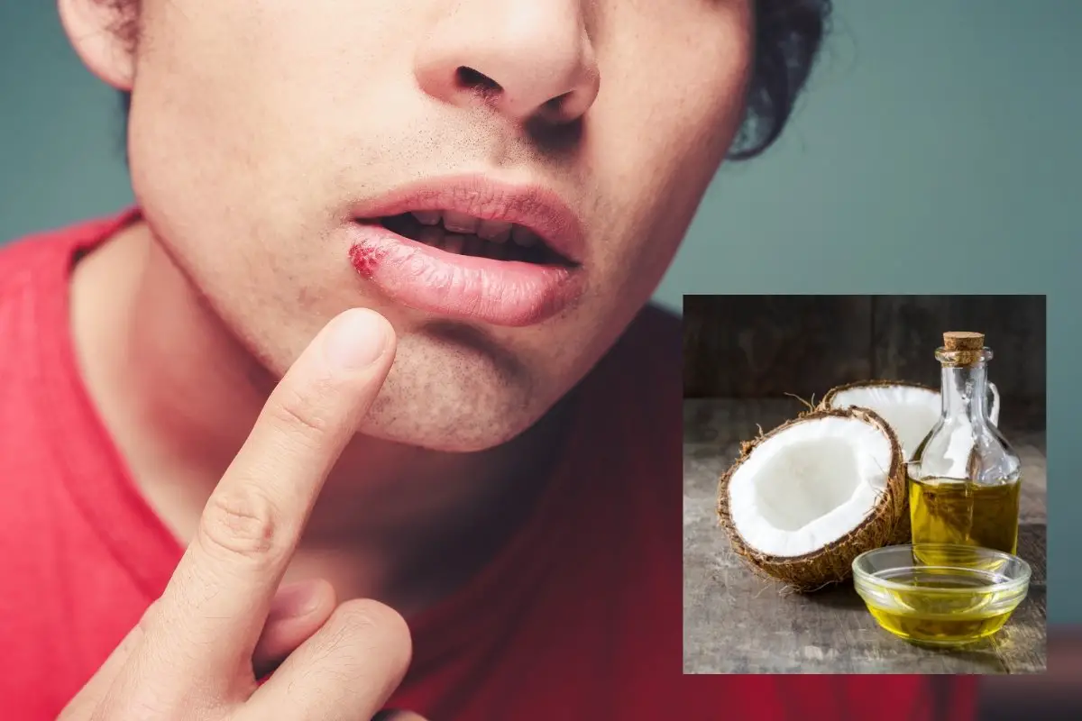 Is Coconut Oil Good For Cold Sores