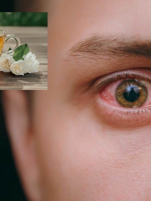 Can I Cure My Pink Eye With Chamomile Tea?