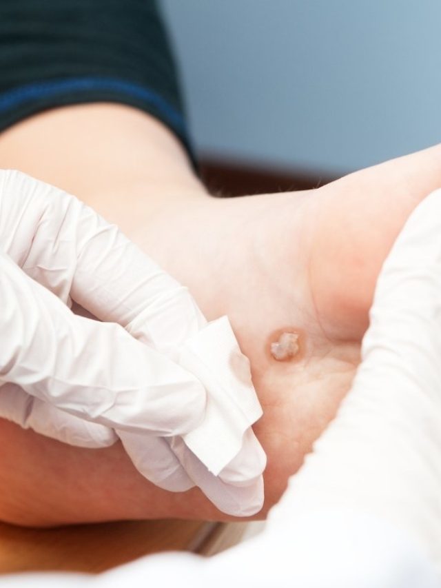 How To Use Colloidal Silver To Cure Warts