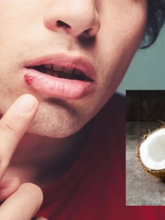 Will My Cold Sores Be Helped With Coconut Oil?